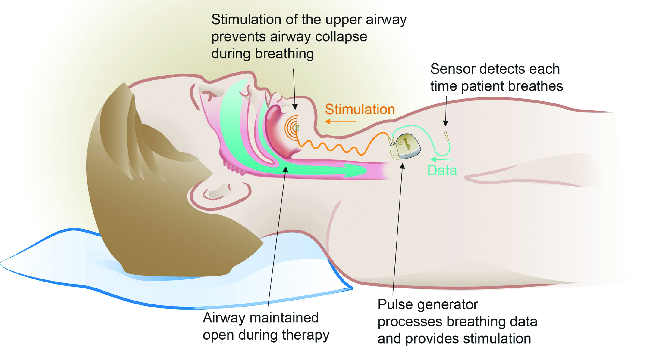 Inspire Sleep Apnea Reviews