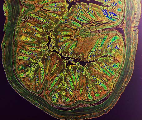 Color-enhanced histologic image showing intestinal tissue damage in a murine model of intestinal inflammation.  Image credit: Drs. Laurel Monticelli and David Artis