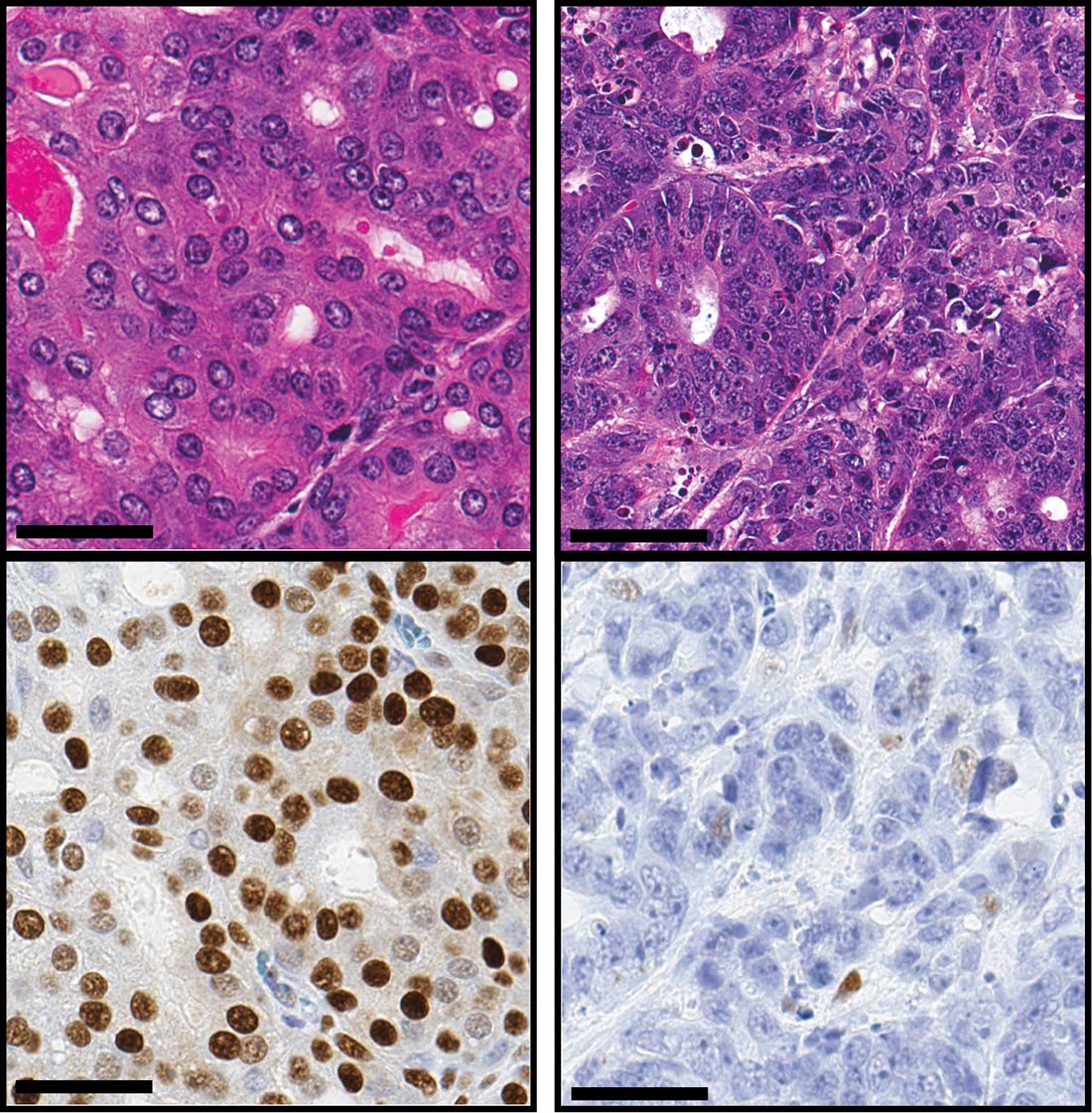 Gene Identified that Drives Aggressive Prostate Cancer