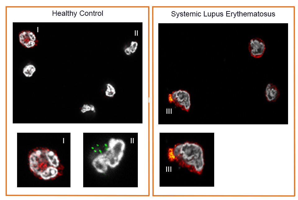 Unique Immune Response in Lupus Paves Way for New Treatment