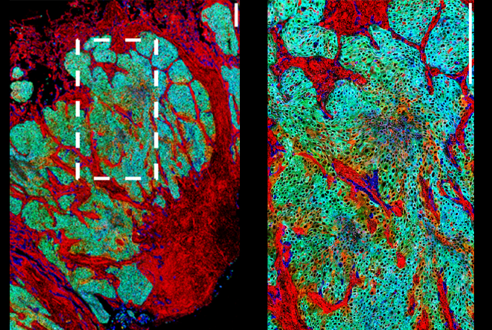 Mapping the Evolution of Urinary Tract Cancer Cells, Newsroom