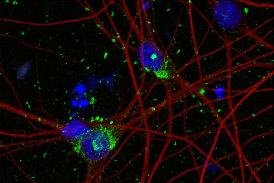 Human Neuron Model Paves the Way for New Alzheimer’s Therapies ...