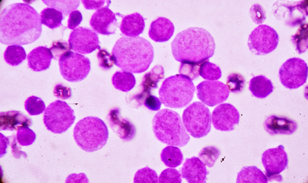 Signs of Acute Myeloid Leukemia May Be Present Years Before Diagnosis
