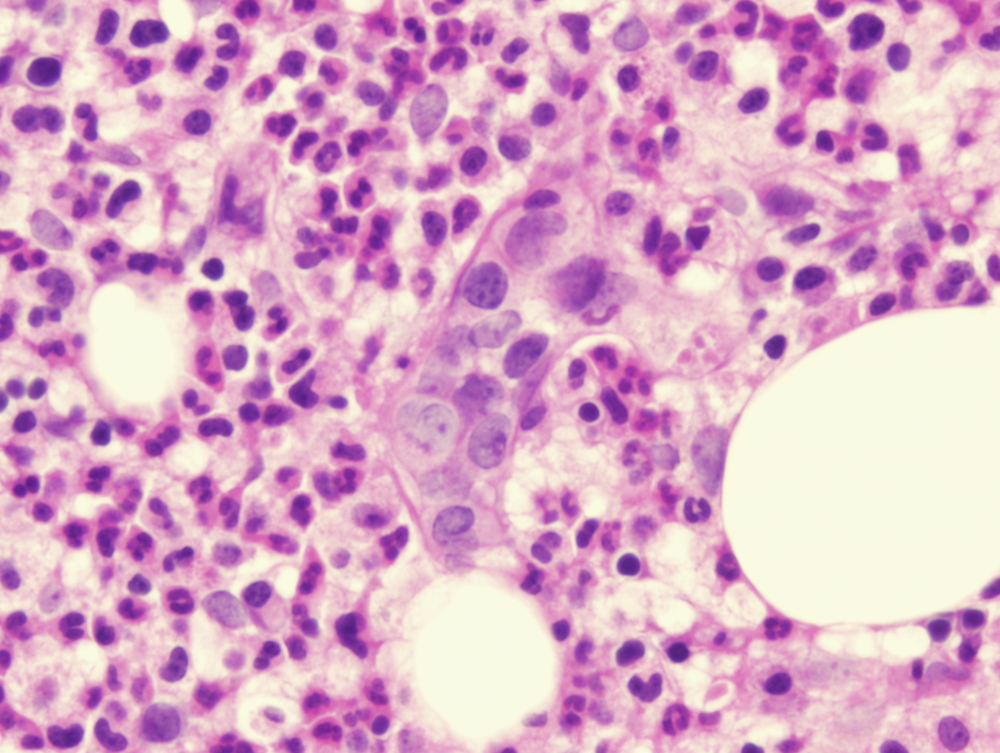 clinical presentation of lymphomas