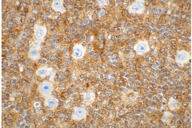 proteins in cancer cells; immunohistochemical staining