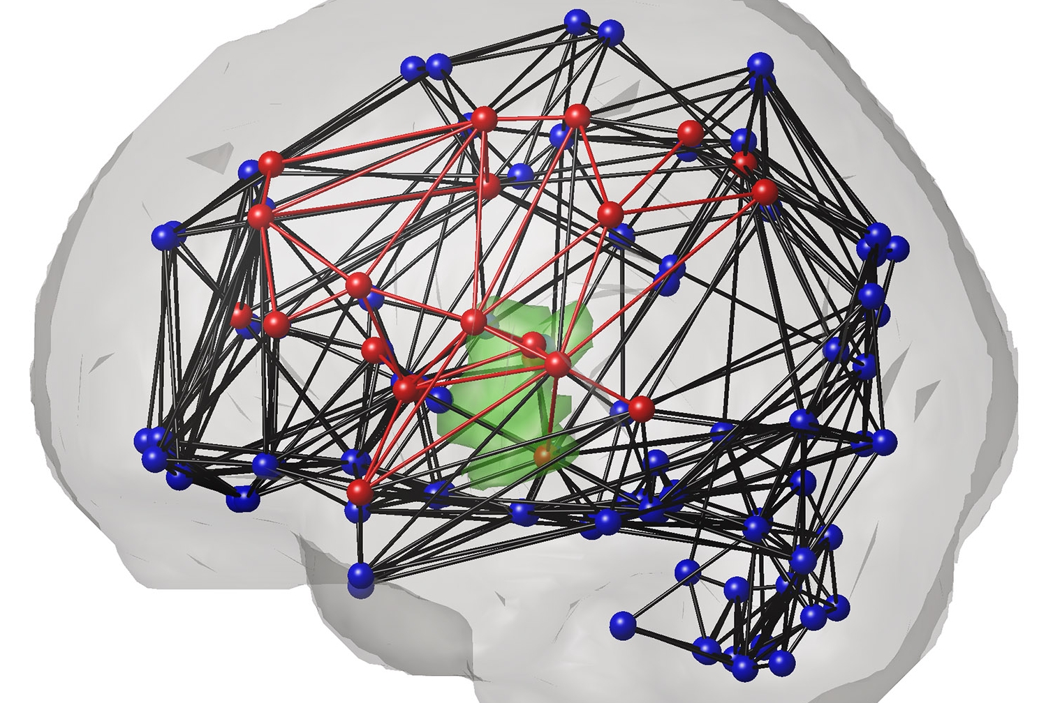 This so-called "glassbrain" visualizes the brain's structural connectivity network and the effects on the network of a particular ischemic stroke lesion, plotted in green. Each sphere represents a different gray matter region, with blue indicating that the stroke had no effect on the gray matter region's connectivity to the rest of the brain and red indicating that the stroke had some effect on the gray matter region's connectivity to the rest of the brain. Pipes between the spheres indicate that a structur