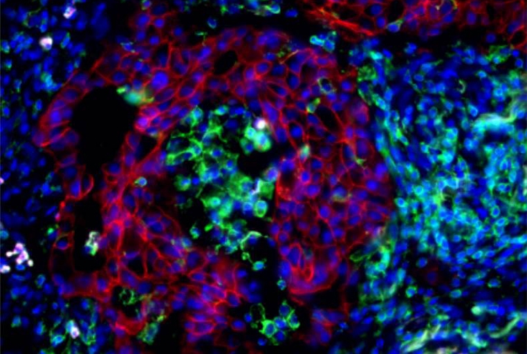 Human lung cancer showing tumor cells (red) and a large number of recruited immune cells (green). Image credit: Mittal Laboratory