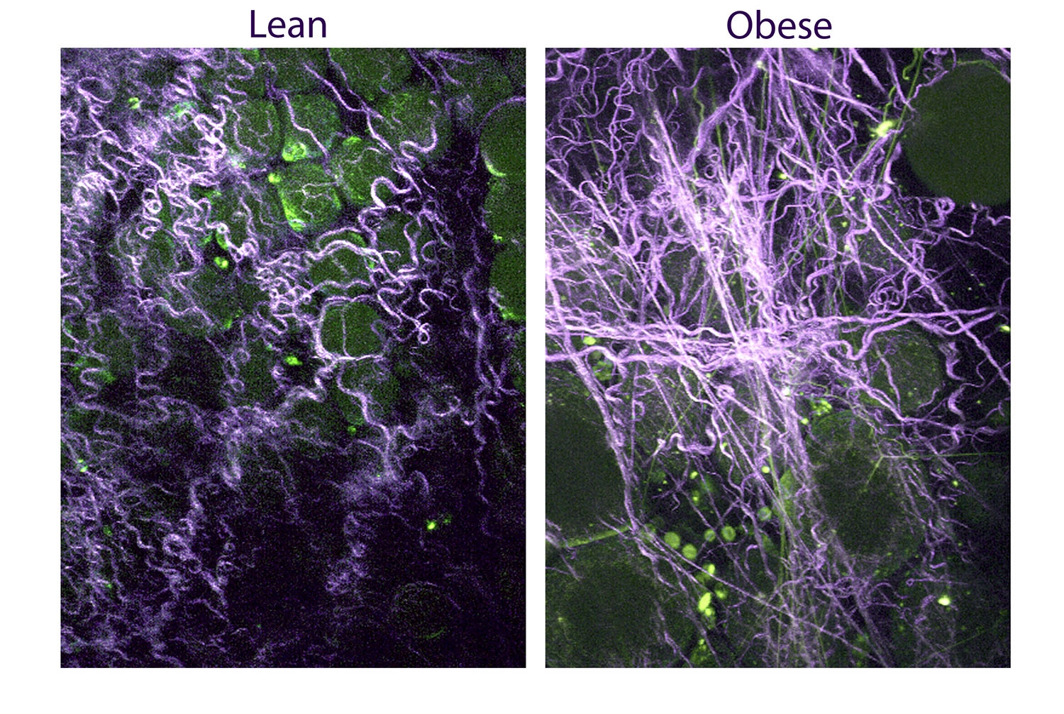 Obesity and breast tissue