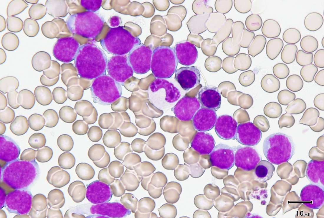 Acute leukemia cells  Image credit: Dr. Mayumi Sugita
