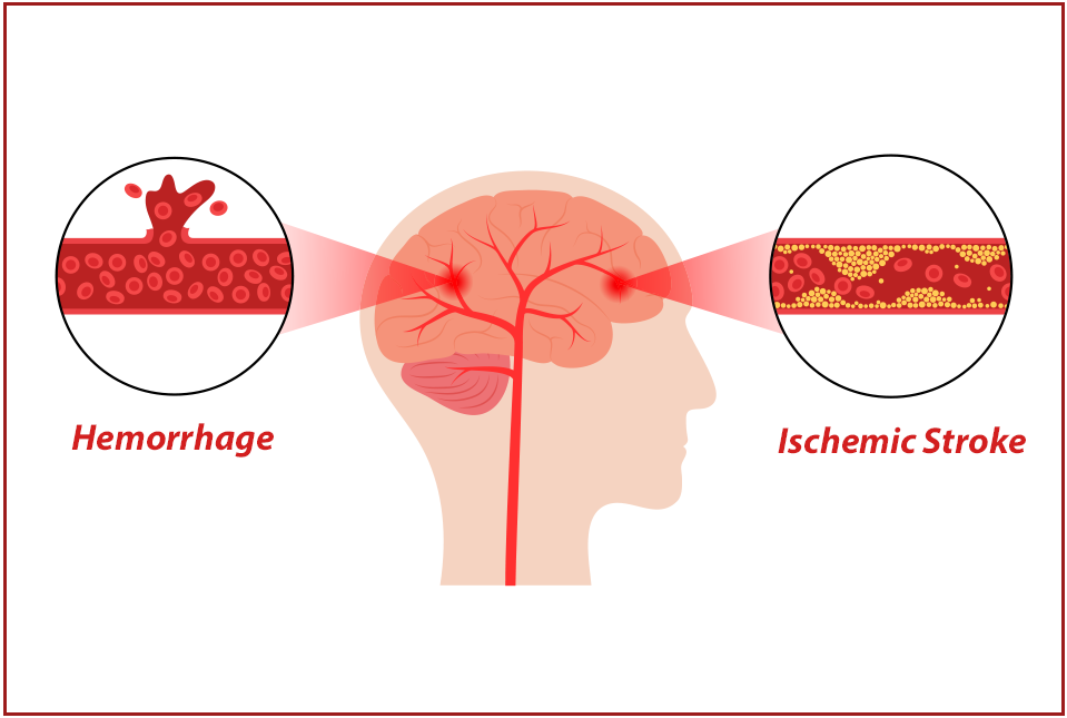 dementia and hemorrhage