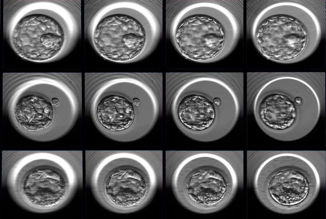 Three examples of human embryos at the blastocyst stage photographed at multiple focal depths (four of seven focal planes shown here, from left to right). The embryos represent good (top), fair (middle) and poor quality (bottom) as designated by the embryologists’ grading system and additional statistical analysis.