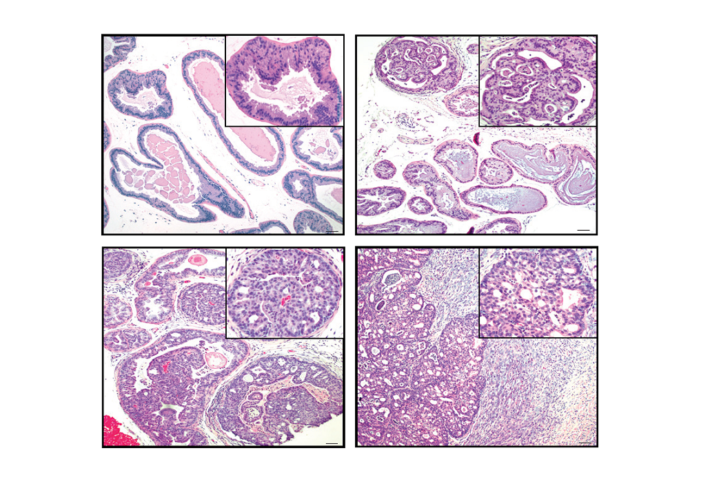 Deletion of CHD1 drives prostate tumor formation in genetically engineered mouse models.