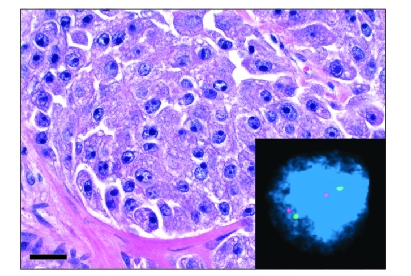 Microscopic images of treatment-resistant prostate cancer