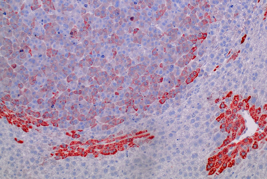Image shows a common form of liver cancer, called hepatocellular carcinoma, produced in mice following the introduction of a tumor-causing mutation in the beta-catenin gene by CRISPR base editing. The staining shows expression of a gene (Glutamine Synthetase) that is activated by mutant beta-catenin in tumors.