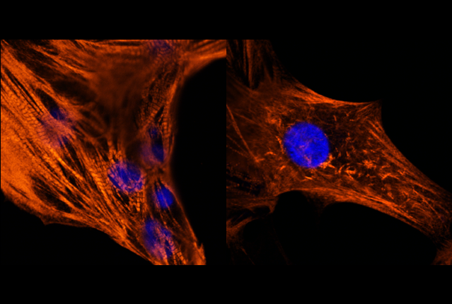 RAF1 mutant cardiomyocytes (right) display increased cell surface area and structural defects compared to cardiomyocytes without the mutation (left). Image courtesy of Circulation