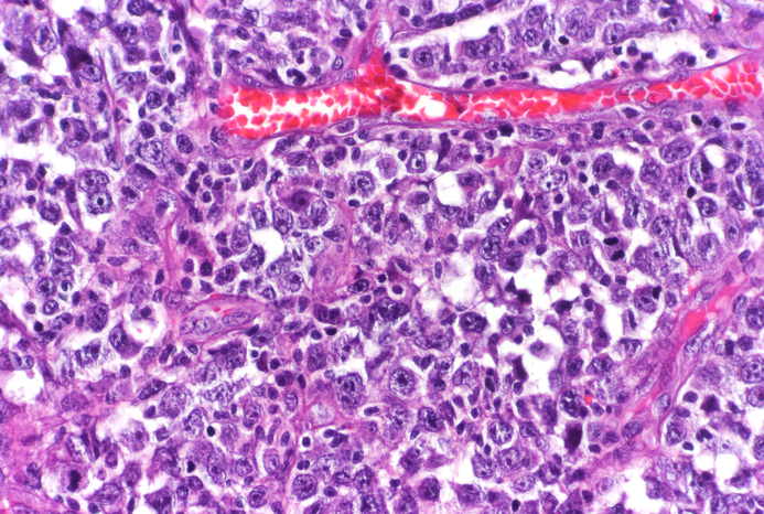 lymphoma cells