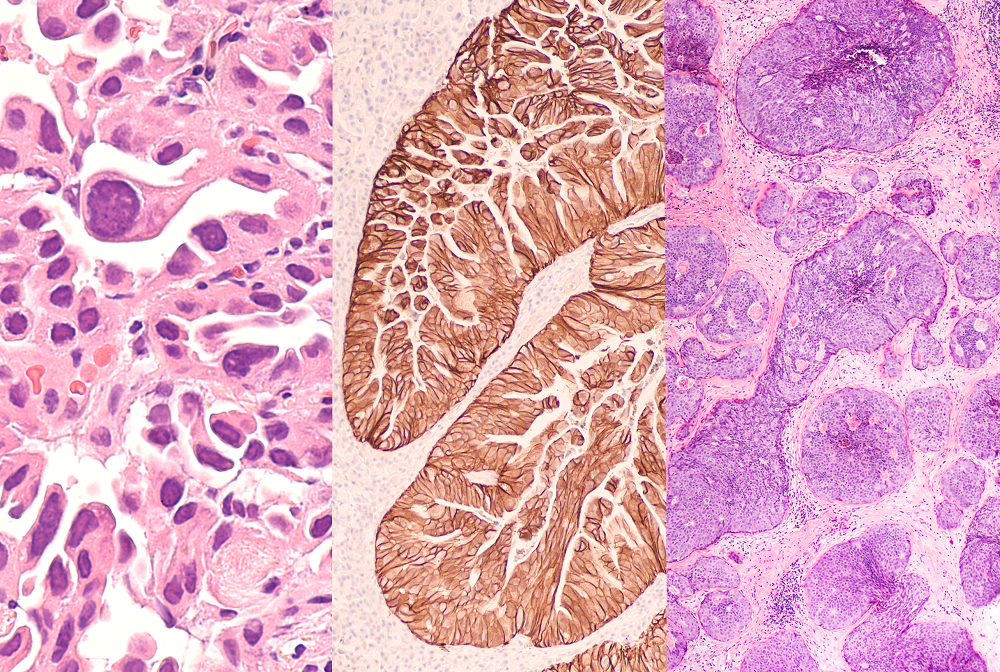 Cells from (left to right) lung cancer, gastric cancer and breast cancer. 