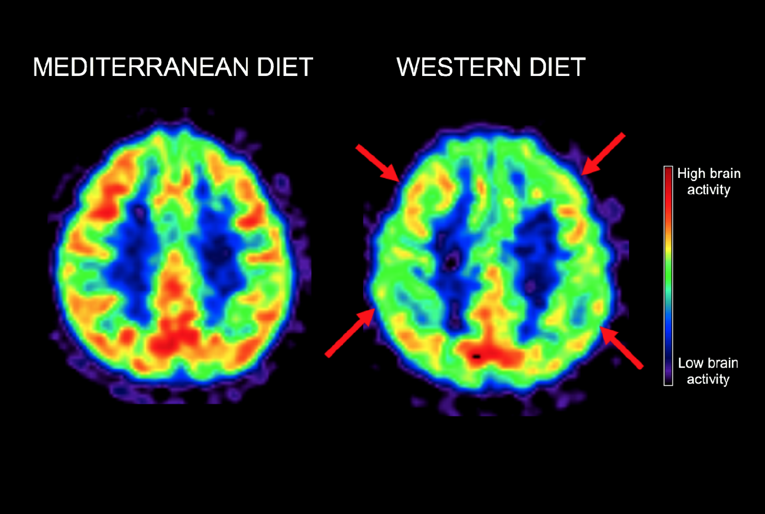 PET scan that shows the brain activity of a 50-year-old woman on a Mediterranean-style diet and of a 50-year-old woman who's followed a Western diet most of her life