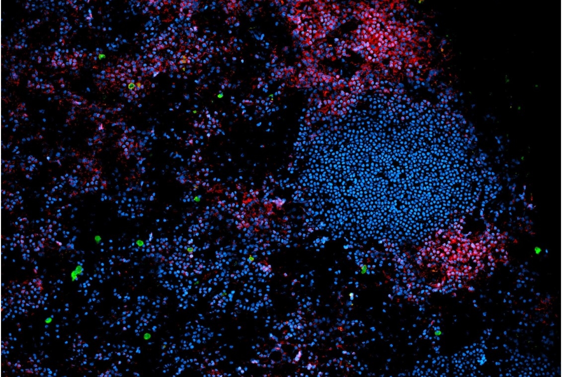 Microscopic visualization of human immune cells in lymph node tissue. 