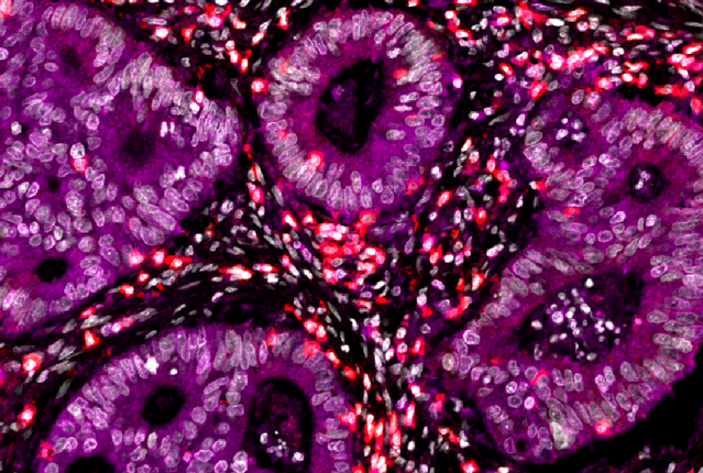 colon cancer cells under microscope