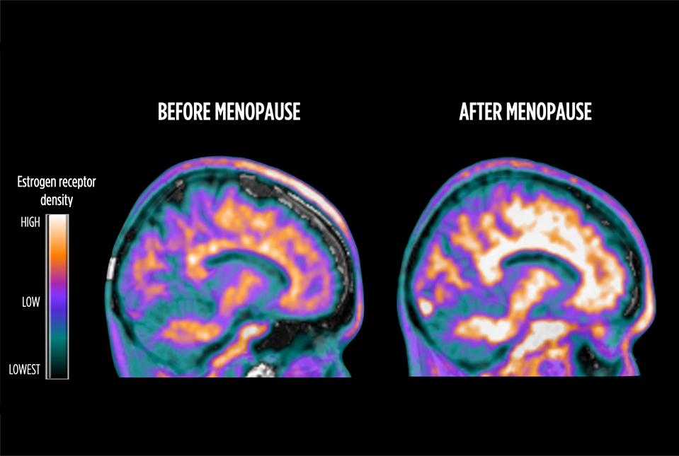PET scan brain images showing estrogen receptor density