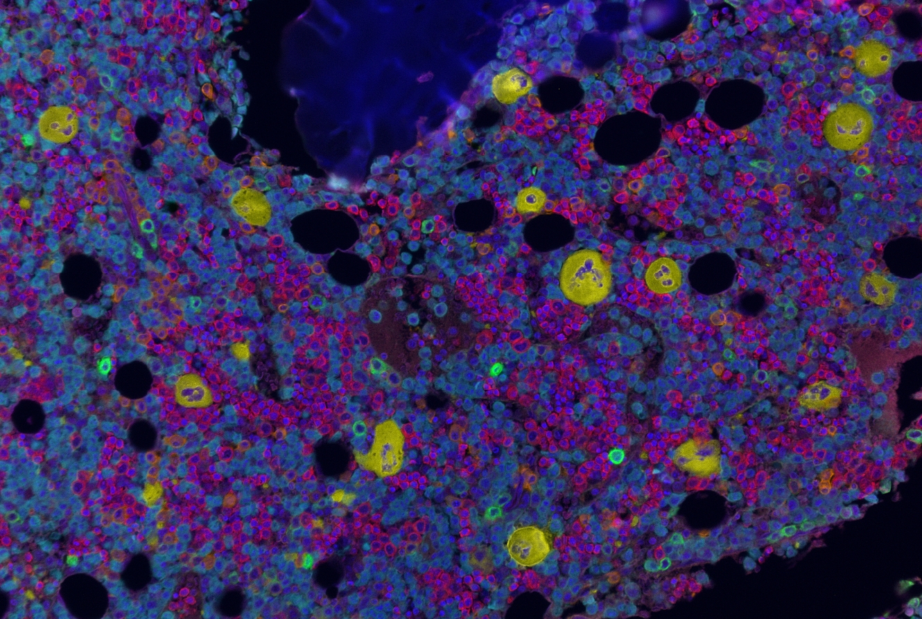image of cells in bone marrow stained yellow, cyan and red
