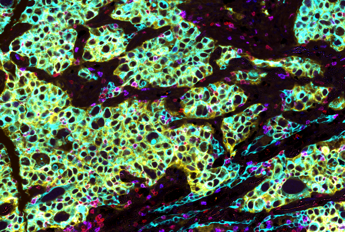 Microscopy image of a early stage human NSCLC, where tumor cells (Cyan) show expression of  PD-L1 (yellow). Also present are T cells (Red) expressing PD-1 (Blue)