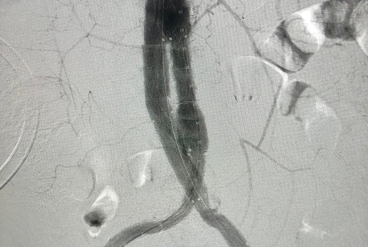 image of Endovascular Aortic Aneurysm Repair