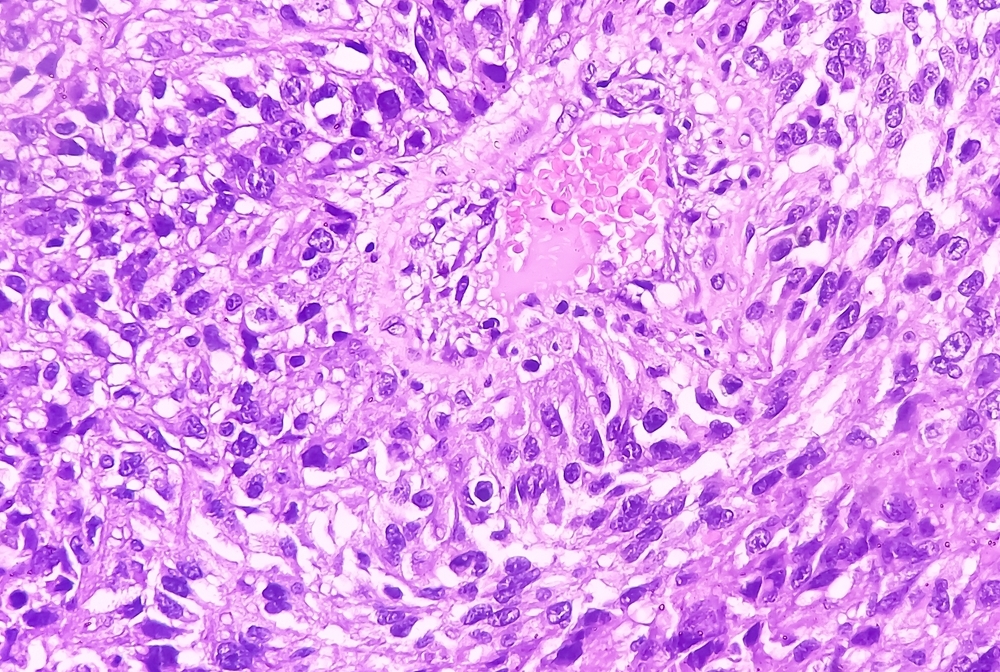 scientific image of kidney cancer, colored in purple