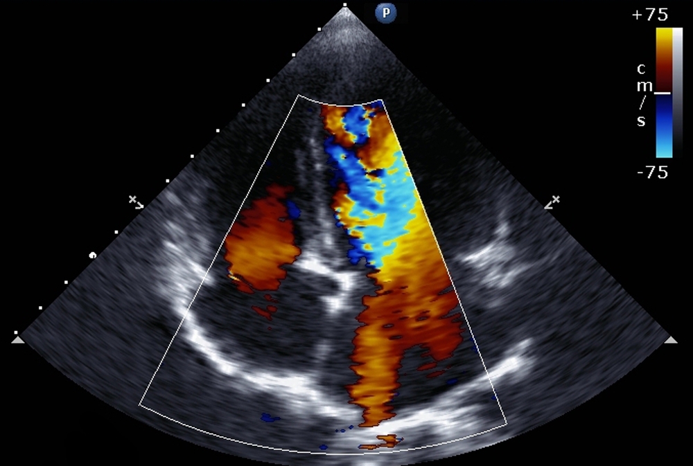 image of transthoracic two-dimensional color Doppler echocardiography