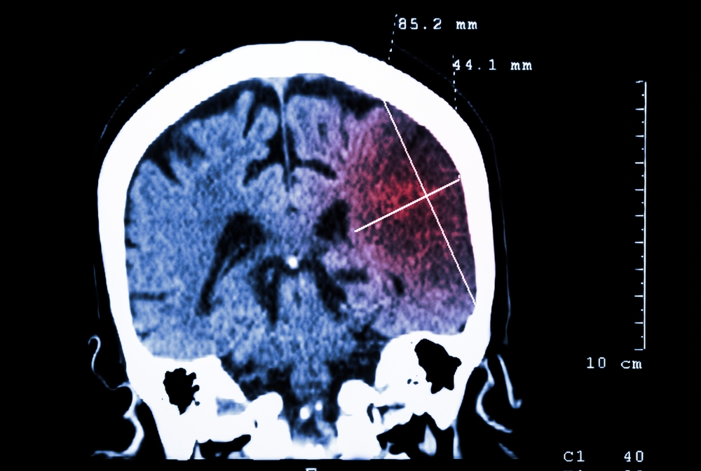 brain scan of a stroke patient