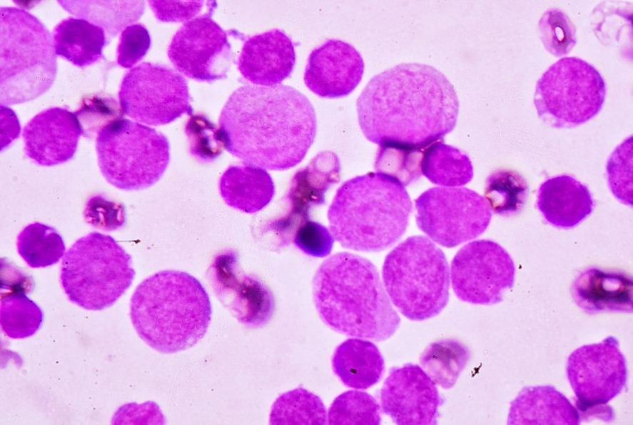 Acute myeloid leukemia microscopic cells