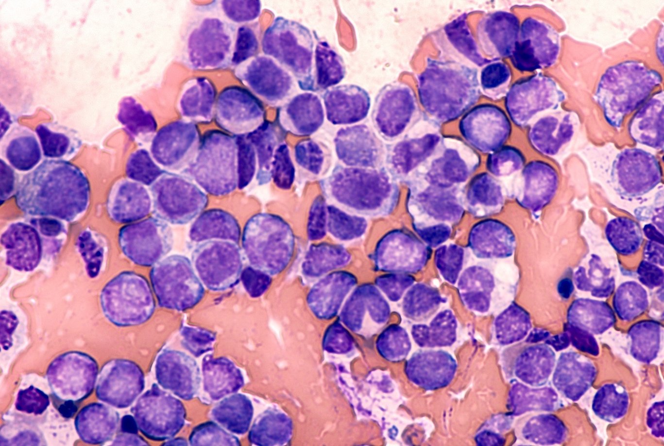  blast cells of acute myeloid leukemia