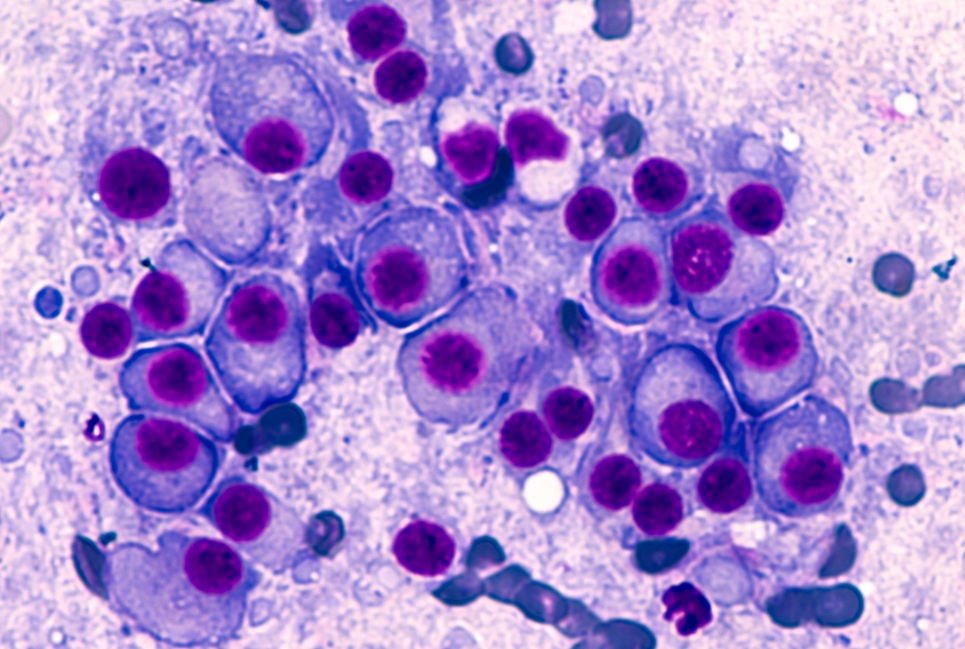 Bone marrow aspirate cytology of multiple myeloma, a type of bone marrow cancer of malignant plasma cells, associated with bone pain, bone fractures and anemia. Image credit: Shutterstock