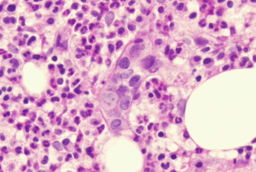 Intravascular large B cell lymphoma
