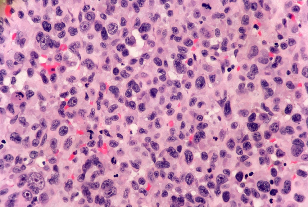 histology of squamous cell carcinoma