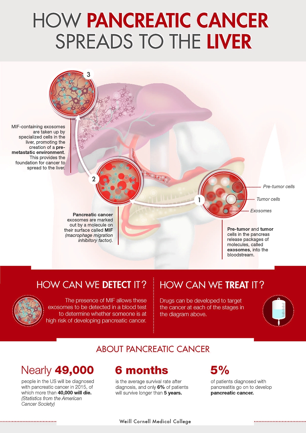 Study Discovers How Pancreatic Cancer Spreads To The Liver | Newsroom ...