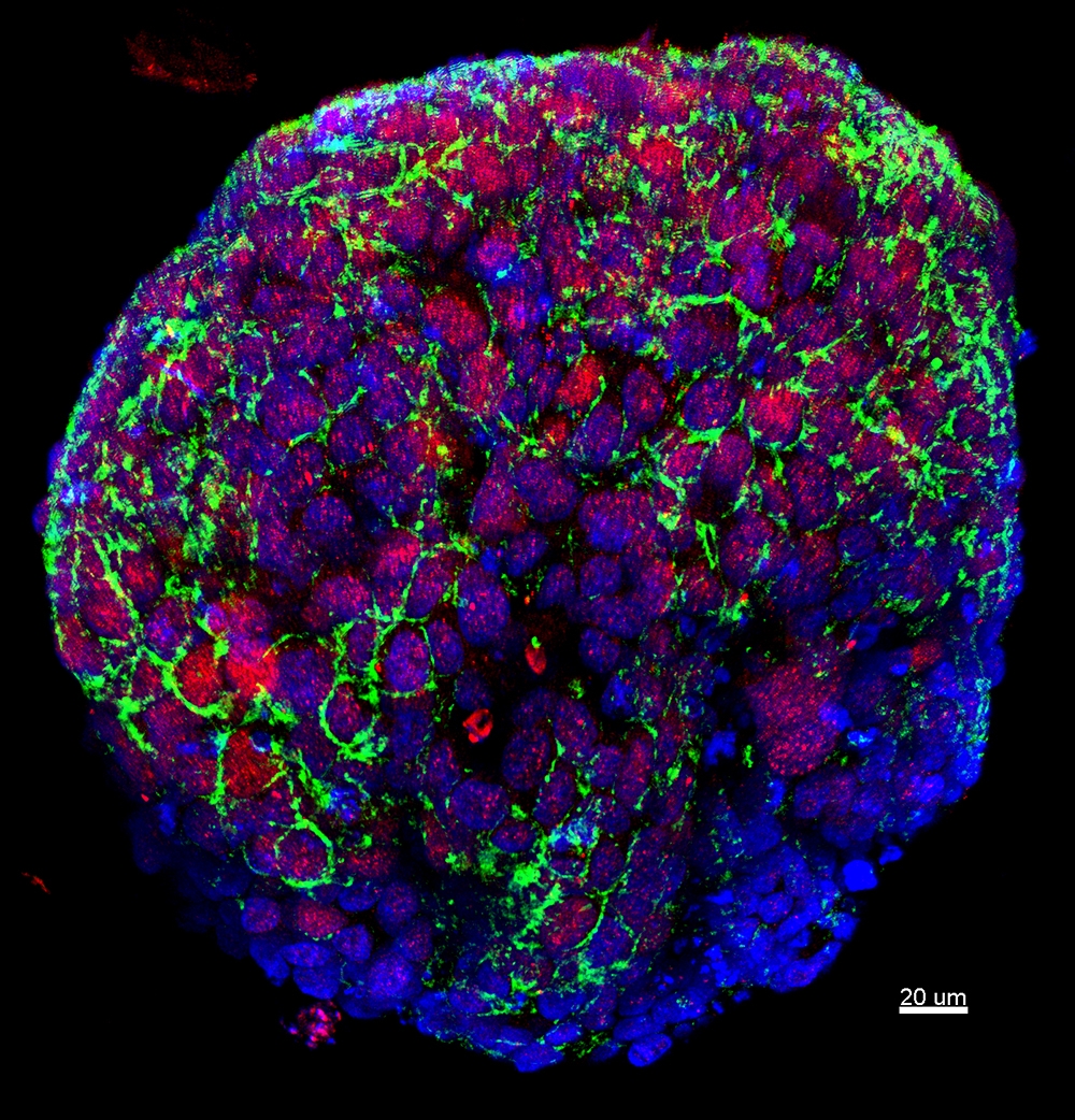 Tumor cells from a biopsy of a patient enrolled in the precision medicine trial 