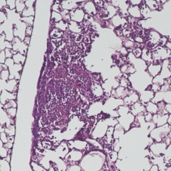 Inflamed lung infected with Pseudomonas