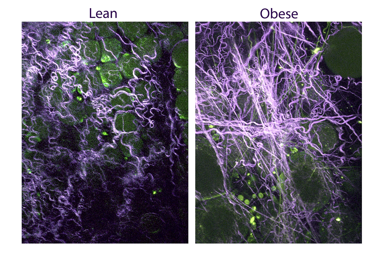 Obesity and breast tissue