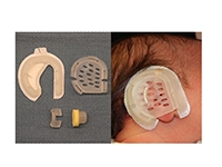 The EarWell Infant Ear Correction System