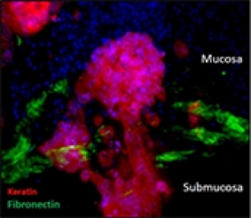 Colorectal cancer progression