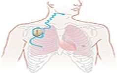 Asthma device inserted under the skin in the upper chest