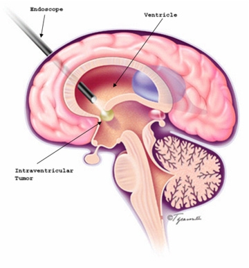 Deep brain tumor