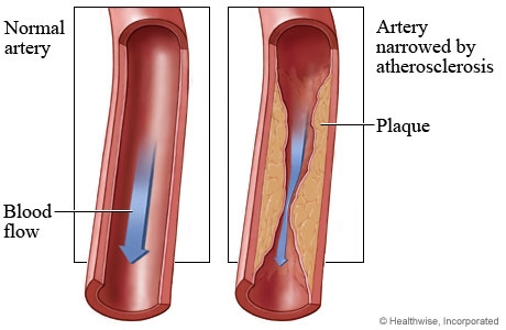 atherosclerosis