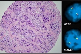 tumors evaluated and the tissue-based assay developed for the study (right).
