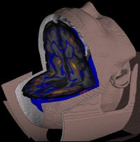This rendering shows a common pattern of metabolic activity in a severely brain-injured patient. Weill Cornell scientists found the same pattern of low activity in 24 patients, no matter how they were hurt, pointing to a new way to assess such patients fo metabolic activity in brain-injured patient