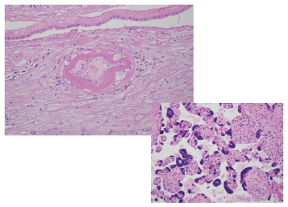 Maternal vascular disease and chorionic villi