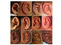 Use of Tapes in Ear Deformities Babies - Dr. Onganlar