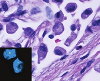 Bladder Cancer Bladder Cancer